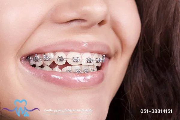 ارتودنسی تک دندان امکان پذیر است؟