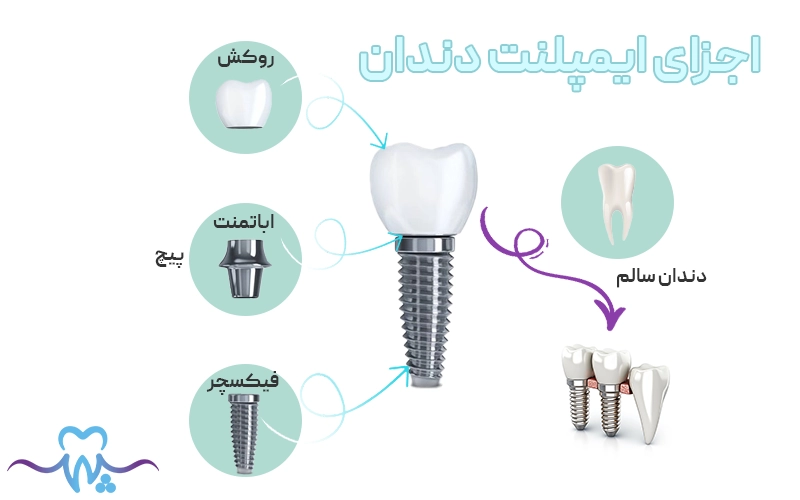 اجزا تشکیل دهنده ایمپلنت