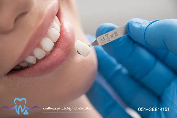 انواع برند های کامپوزیت دندان