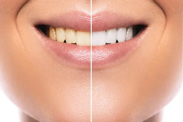 انواع برندهای کامپوزیت دندان و ویژگی هر کدام