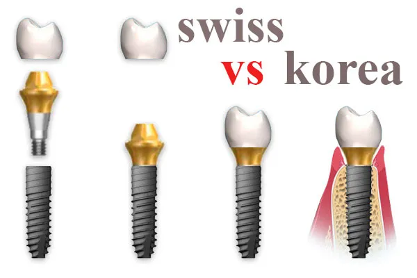مزایا و معایب ایمپلنت کره ای
