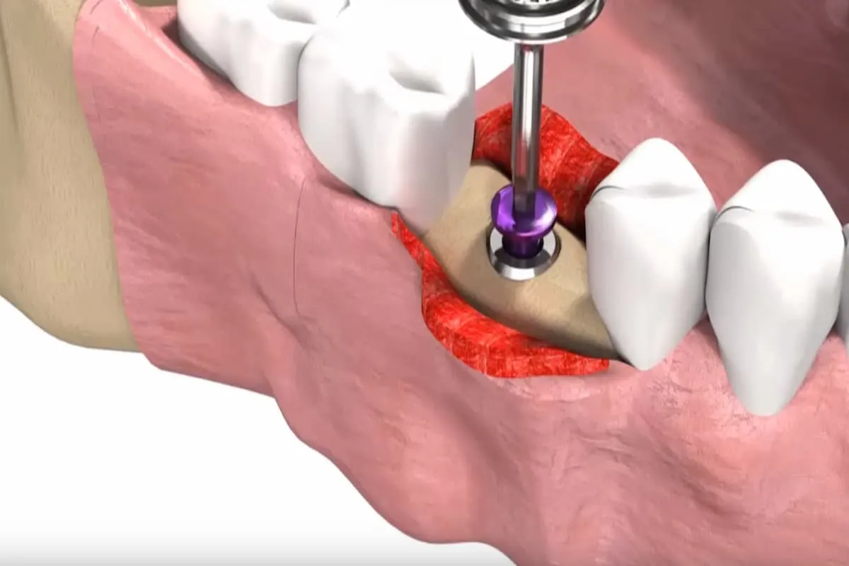 تصویر دندان های متصل شده به پیچ برای جای‌گذاری ایمپلنت با کیفیت