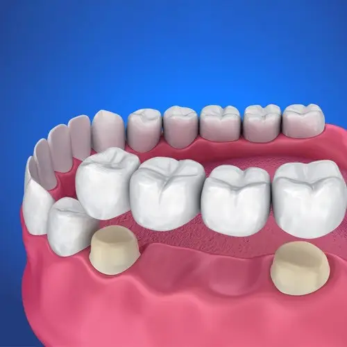 تفاوت‌های کلیدی بین بریج و ایمپلنت دندان
