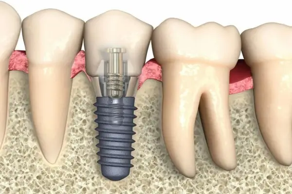 ایمپلنت دندان برای افراد میانسال: مزایا و چالش‌ها