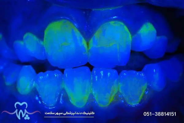 بلیچینگ یا جرم‌گیری دندان: کدوم برای شما بهتره؟