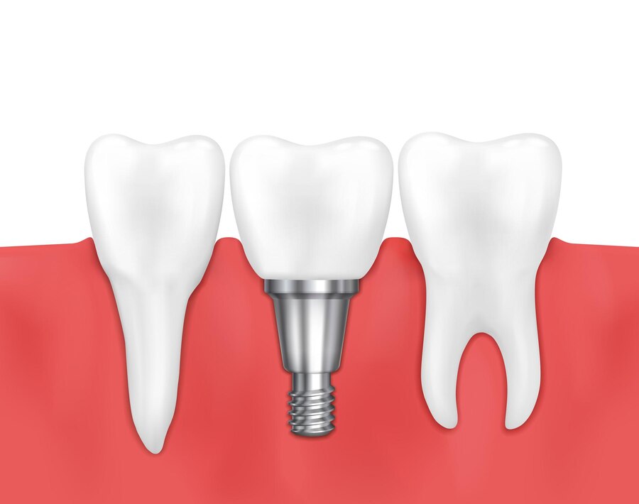 ایمپلنت چطور جایگزین دندان‌ می شود