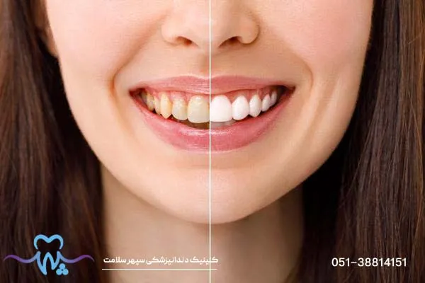جرم‌گیری و پالیش لمینت دندان؛ راهنمای کامل برای حفظ درخشندگی لبخند