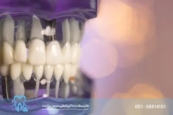 ایمپلنت دندان