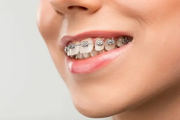 هزینه ارتودنسی در کلینیک دندانپزشکی سپهر سلامت