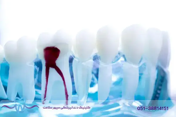 درمان ریشه