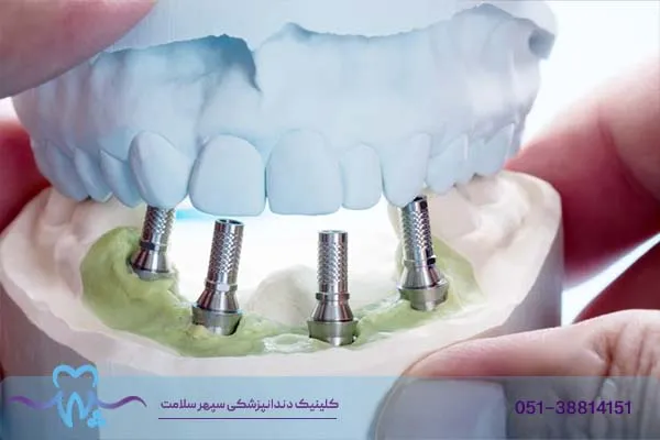 ایمپلنت چهار دندان کنار هم چگونه است؟