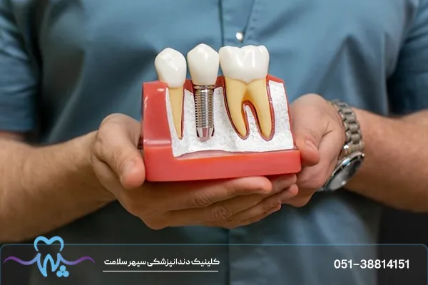 چه کسانی نباید ایمپلنت انجام دهند؟