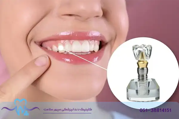 همه‌چیز درباره مینی ایمپلنت دندان؛ مزایا، معایب و هزینه در مشهد