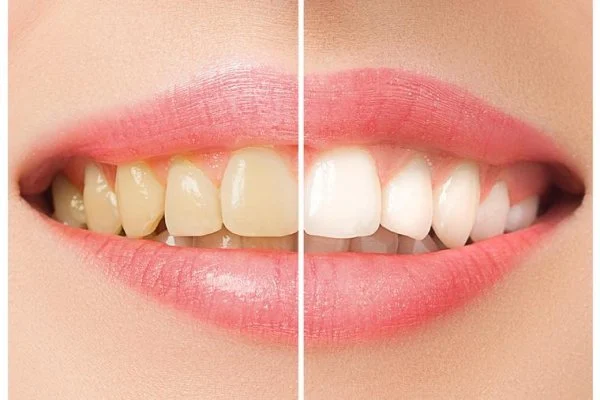 بلیچینگ دندان چیست و چگونه عمل می‌کند؟