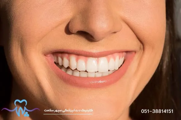 باندینگ دندان چیست؟
