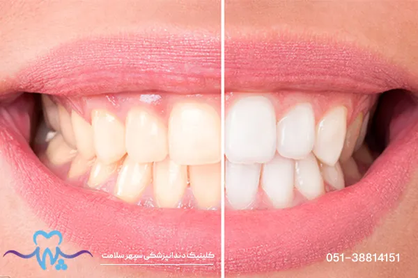 میزان تراش دندان برای کامپوزیت چقدر است؟