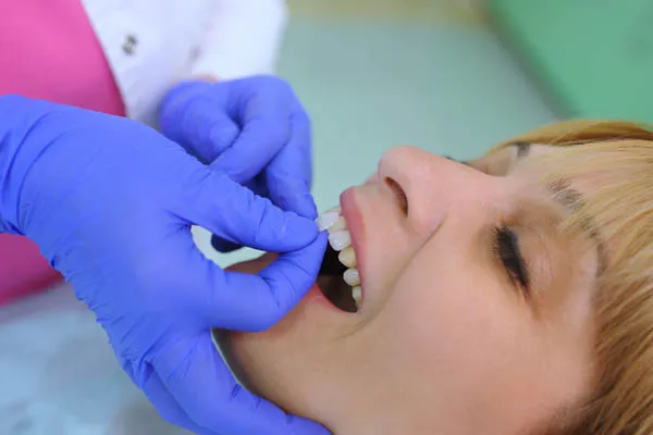 چه افرادی کاندیدای مناسبی برای لمینت دندان خرگوشی هستند؟