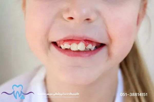 جرم‌گیری دندان کودکان: چرا و چگونه به سلامت دهان آنها کمک می‌کند؟