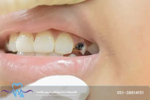 سیاه شدن دندان در بزرگسالان؛ علل، درمان و پیشگیری