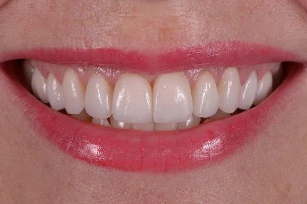 نکات مراقبتی برای حفظ ترمیم‌های بایومیمیتیک