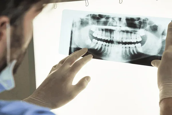 درمان ایمپلنت به CBCT