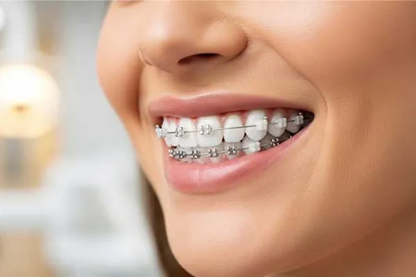 آیا بعد از ارتودنسی می‌توان لمینت انجام داد؟