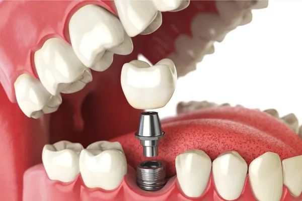 مزایای استفاده از CBCT در کلینیک‌های تخصصی