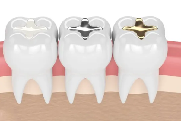 چگونه ماندگاری پرکردگی دندان را افزایش دهیم؟