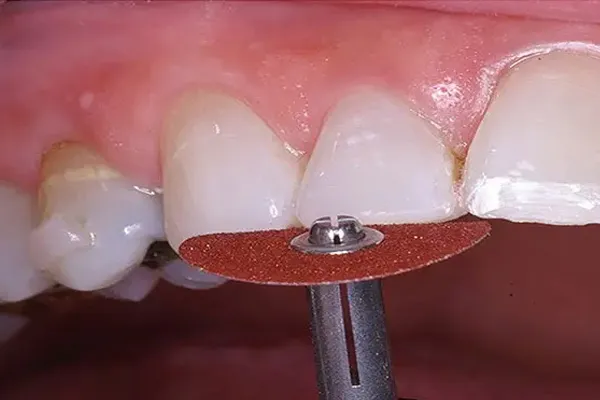 لمینت دندان برای چه افرادی مناسب است؟