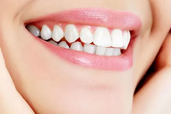 هزینه لمینت بعد از ارتودنسی