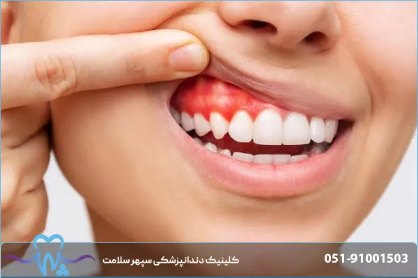 پریودنتیت چیست؟ علائم، مراحل پیشرفت بیماری لثه و روش‌های درمان