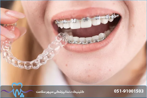 تفاوت ارتودنسی ثابت و متحرک چیست؟ بررسی هزینه، مدت درمان و مزایا