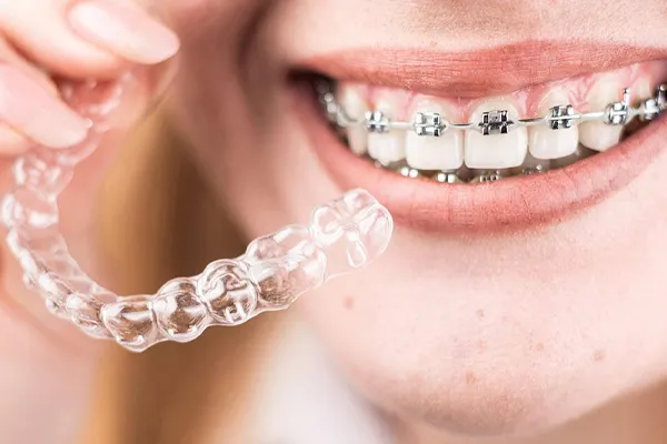 تفاوت ارتودنسی ثابت و نامرئی؛ کدام روش برای شما مناسب‌تر است؟