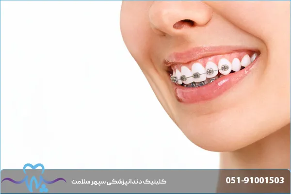 مراحل ارتودنسی دندان از اولین جلسه تا پایان درمان؛ راهنمای کامل