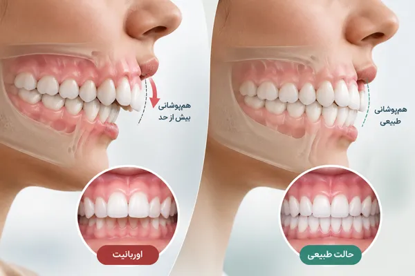 اوربایت چیست؟ علائم، علت‌ها و روش‌های درمان در کودکان و بزرگسالان