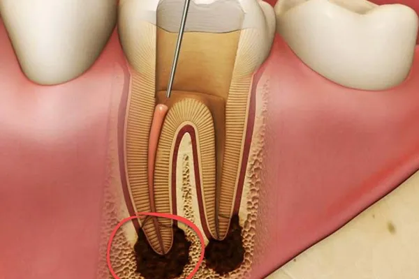 عصب‌کشی مجدد دندان چیست؟ علائم نیاز به درمان مجدد ریشه و مراحل آن