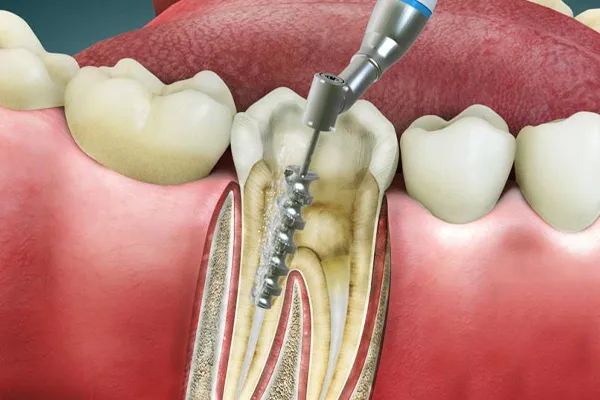 عصب‌کشی مجدد دندان چیست؟ علائم نیاز به درمان مجدد ریشه و مراحل آن