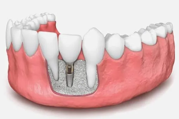 پیوند استخوان برای ایمپلنت چیست و چه زمانی لازم است؟