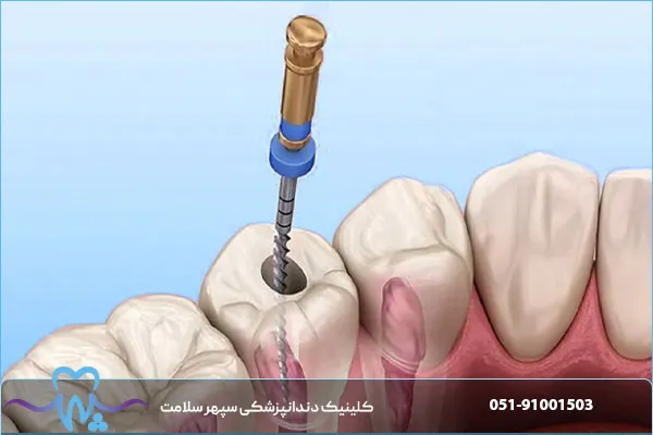 آیا دندان عصب‌کشی‌شده به روکش نیاز دارد؟ بررسی شرایط و ضرورت درمان