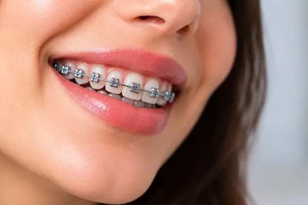 رعایت بهداشت دهان و تمیز کردن تجهیزات ارتودنسی