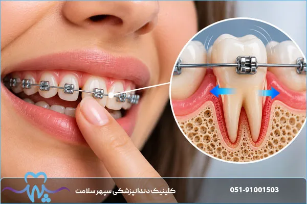 تحلیل ریشه دندان در ارتودنسی چیست؟ علت، علائم و روش‌های پیشگیری