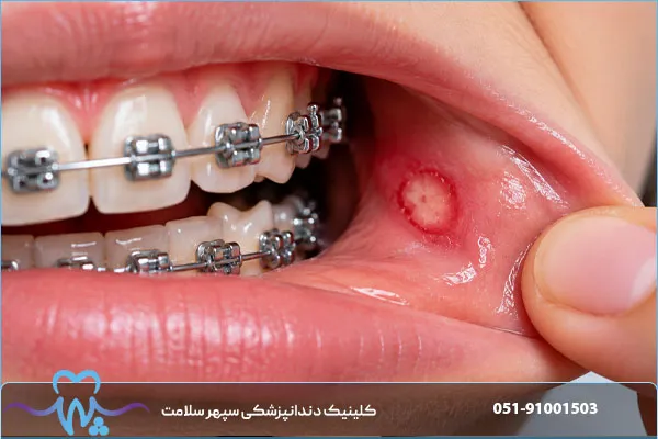 زخم دهان در ارتودنسی؛ علت، روش‌های درمان و راه‌های پیشگیری